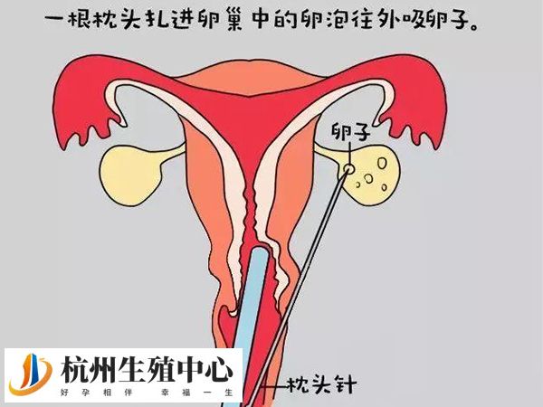 做取卵手术要3000元