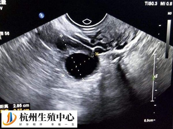 B超监测卵泡是人工授精流程之一