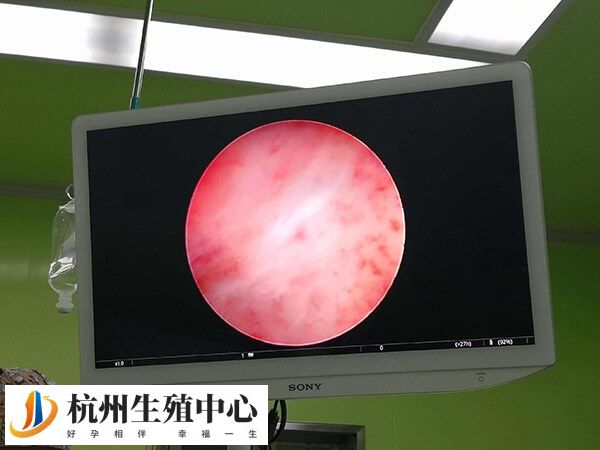 子宫内膜异常不利于胚胎着床