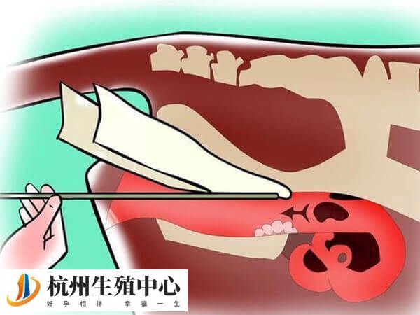 为什么不建议做人工授精